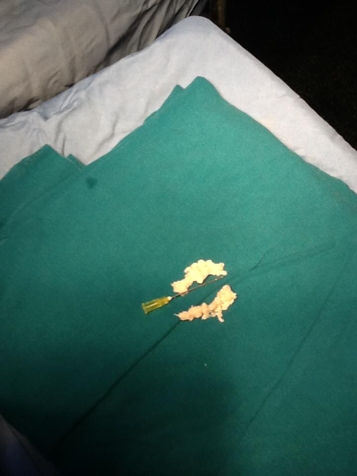 جراحی آندوسکوپی دیسک کمر